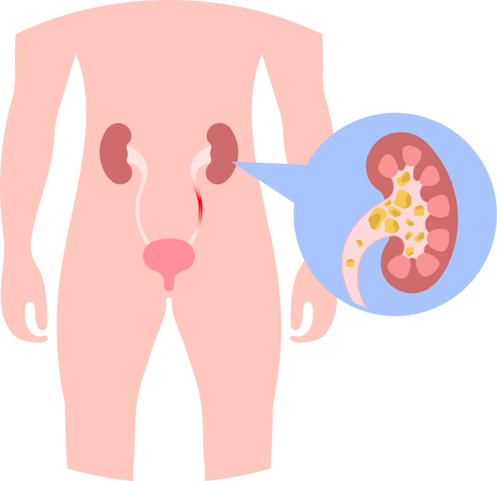 Incontinence proteinuria uremia dysuria hemoglobinuria pee sample bacteria hematuria nephrotic syndrome exam protein liver lab urination pain frequent Acidity PH level damage acid Bilirubin