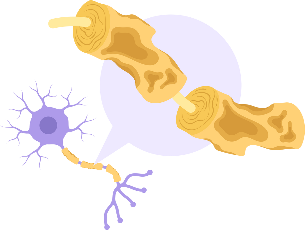 syndrome schwann cell neuron axon neurone Motor neurological electrical signal encephalomyelitis nerve central myelin sheath disease damage multiple sclerosis brain demyelination guillain barre